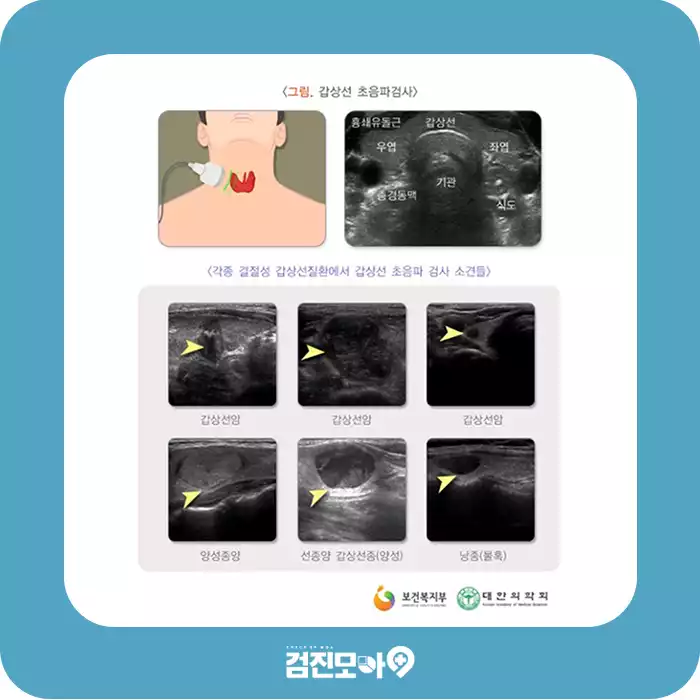 검진정보(갑상선초음파)1-1.jpg